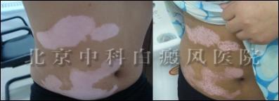 曹某20天康复照片