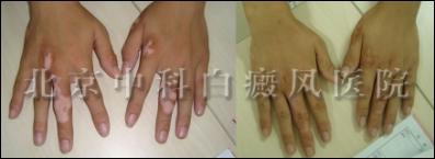 患者张某康复照片